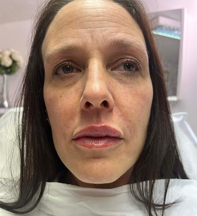Subtle Lip Enhancement - restoring hydration and volume to the lips for a rejuvenated, youthful appearance